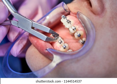 Dentist checking up teeth with brackets using dental tools at the dental office. Macro shot of teeth with braces. Orthodontic Treatment. Dentist checking bracket at the braces on the female patient.