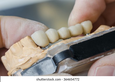 A dentist / dental technician placing the fixed partial denture ( the dental bridge) on the implants.