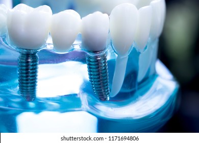 Zahnzahnzahnarztlehrmodell mit Titan-Zahn-Implantatschraube.