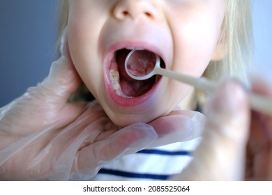 dentist, doctor examines oral cavity of small patient, uses mouth mirror, closeup baby teeth child, concept pediatric dentistry, dental treatment, correction of occlusion, oral care, caries prevention