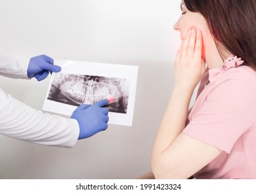 A dentist doctor is holding a panoramic X-ray picture of a female patient who has an inflamed dental cyst, a neoplasm. Removal of a dental cyst, malignant tumor