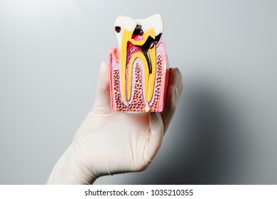 Dentist. Doctor Holding Tooth Model. Concept Restoration, Treatment For Caries.