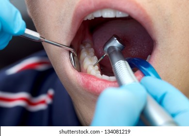 The Dentist Drill The Tooth With A Turbine