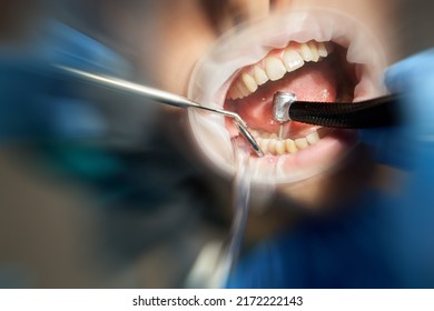 Dentist Drilling Tooth To Male Patient In Dental Chair With Motion Blur Effect