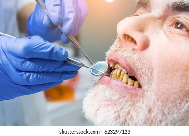 Dentist Examining Patient, Close Up. Elderly Male With Bad Teeth. Tobacco Use Influences Dental Health.