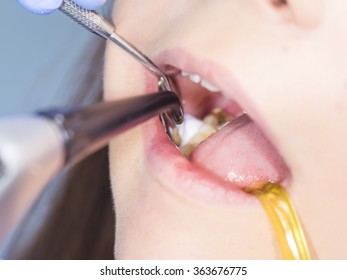 Dentist filling woman's teeth with composite material.