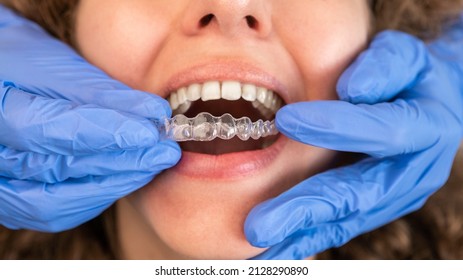 Dentist In Gloves Applying Invisible Aligner On Female Patient Teeth At Modern Clinic. Orthodontic Removable Straighteners In Dentist Office. Dental Treatment Concept.