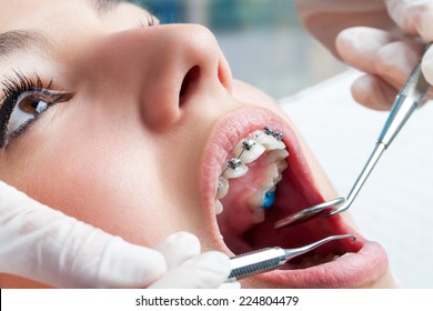 Dentist Hands Working On Young Teen Patient With Dental Braces.