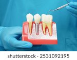 Dentist holding dental implant, artificial tooth roots into jaw, root canal of dental treatment, gum disease, teeth model for dentist.