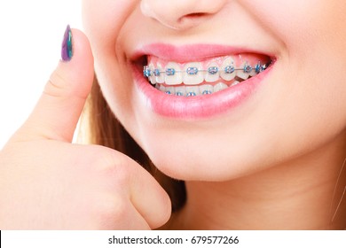 Dentist And Orthodontist Concept. Woman Smile Showing Her White Teeth With Blue Braces, Thumb Up Gesture.