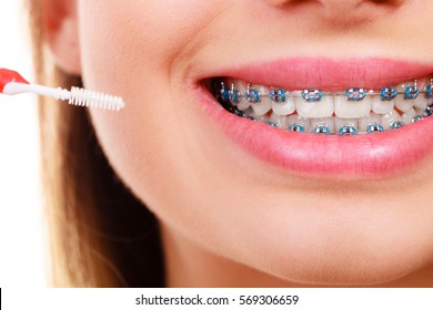 Dentist and orthodontist concept. Young woman cleaning and brushing teeth with blue braces using toothbrush