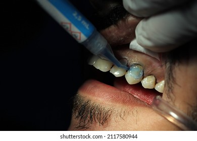 Dentist placing acid on an upper tooth as part of the bonding of a restoration.