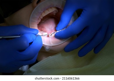 Dentist puts the thread to stop the bleeding between tooth and gum of the patient. Close-up of the oral cavity in the process of dental treatment. Dentistry, prosthetics concept. Orthodontist cure.