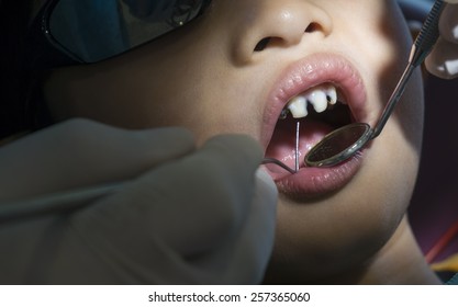 Dentist Removing Tooth Decay 'caries'