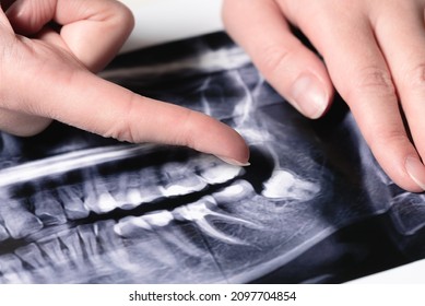 Dentist Show By Her Finger On The Milk Tooth On The X-ray Teeth Image Close Up.