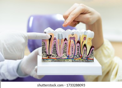 Dentist Showing Tooth Model To Teach Patient To Take Care Of Dental Health, Prevent Dental Carries And Explain Treatment Option. Orthodontics And Medical Concept