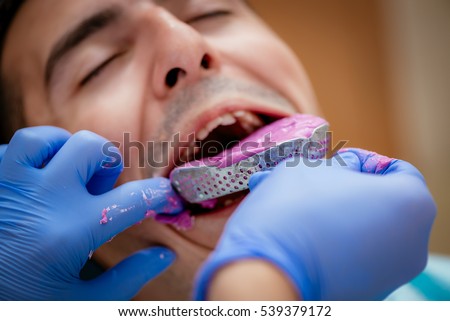 Dentist using dental impression for braces to the male patient. Close-up. Real people.