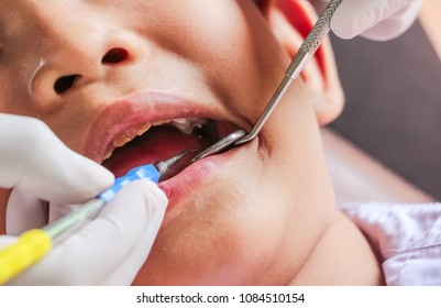 Dentist using of professional equipment for dental treatment of young asian young boy laying with mouth wide open while dentist examining his teeth with mirror. - Shutterstock ID 1084510154