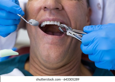 Dentist Using Surgical Pliers To Remove A Decaying Tooth In Clinic