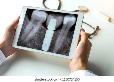 Dentist Watching A Dental X-ray Teeth With Dental Pivot On Digital Tablet. 