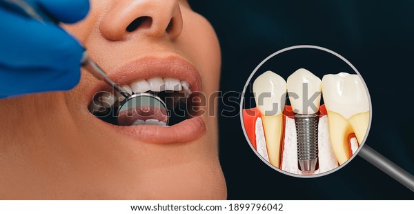 Dentistry, dental\
prosthetics advertising. Dental implant near the patient\'s open\
mouth. Modern\
stomatology