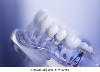 Dentists tooth plastic model with decay used for teaching, learning and patients in dental office showing teeth and gums.