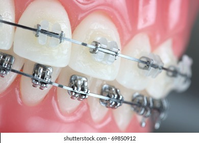 Denture with braces