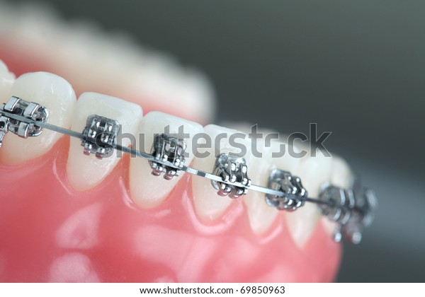 Denture Braces Stock Photo 69850963 | Shutterstock