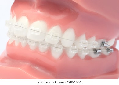 Denture with brackets