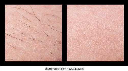 Depilation And Sugaring. Hair Removal. Follicle. Woman Leg With Sugar Or Wax. Before And After. Process And Steps Of Depilation.