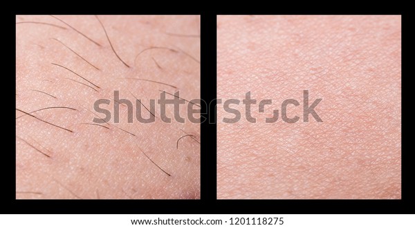 Depilation Sugaring Hair Removal Follicle Woman Stock Photo Edit