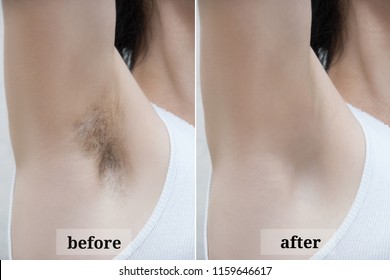 Depilation zone underarms. Before and after.