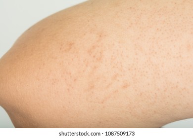 Dermatitis and abnormal in Upper arm