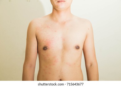 Similar Images, Stock Photos & Vectors of Scar from open heart surgery