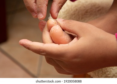 Dermatitis In The Feet And Hands Of A Teenager Peeling Skin From His Big Toe. Athlete's Foot Due To Poor Sanitation And Fungal Infection