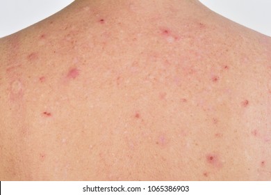 Close Allergy Rash Around Back View Stock Photo 1565878609 | Shutterstock