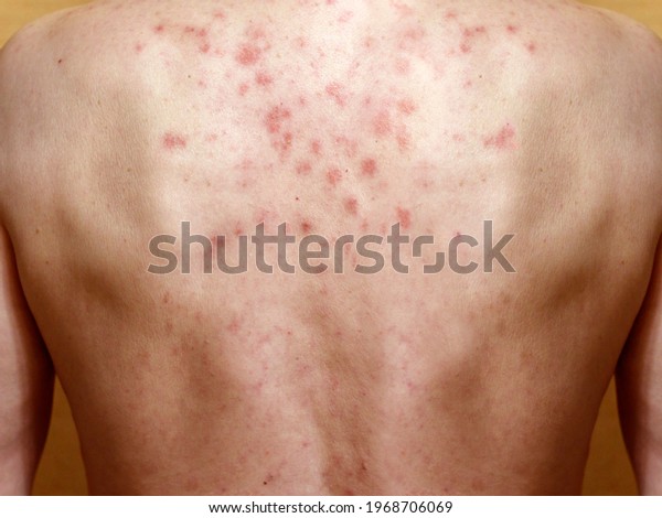 Dermatitis on\
skin of a man`s back. Allergic reaction. Allergic rash on chest\
skin. Dermatitis. Seborrheic\
dermatitis