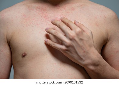 Dermatitis Rash Viral Disease With Immunodeficiency On Body Of Young Adult Asian, Scratching With Itching, Measles Virus, Viral Exanthem