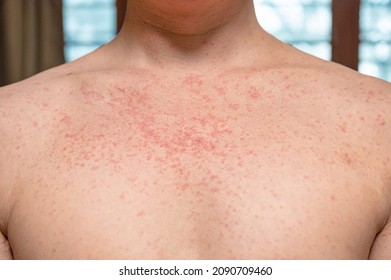 Dermatitis Rash Viral Disease With Immunodeficiency On Body Of Young Adult Asian, Scratch With Itch, Measles Virus, Viral Exanthem