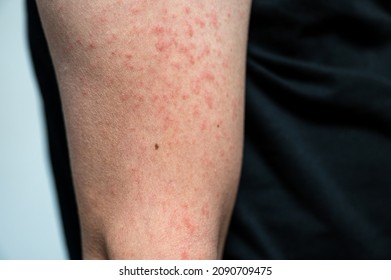 Dermatitis Rash Viral Disease With Immunodeficiency On Arm Of Young Adult Asian, Scratch With Itch, Measles Virus, Viral Exanthem