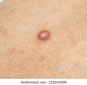 Dermatofibroma En La Pierna De Mujer Stock Photo 2153145295 | Shutterstock