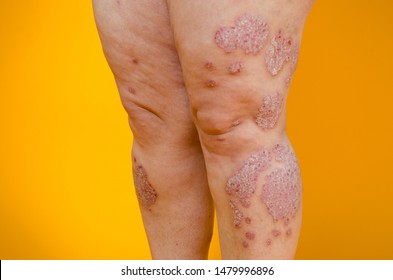 Psoriasis Leg Images Stock Photos Vectors Shutterstock