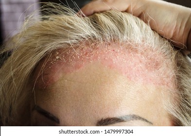 Dermatological Skin Disease. Psoriasis, Eczema, Dermatitis, Allergies. Skin Lesions On The Head. Red Areas On Forehead And Ears.