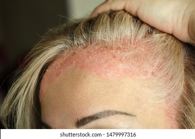 Dermatological Skin Disease. Psoriasis, Eczema, Dermatitis, Allergies. Skin Lesions On The Head. Red Areas On Forehead And Ears.