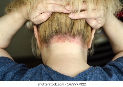 Dermatological skin disease. psoriasis, eczema, dermatitis, allergies. Skin lesions on the head. Red areas on forehead and ears. - Shutterstock ID 1479997322