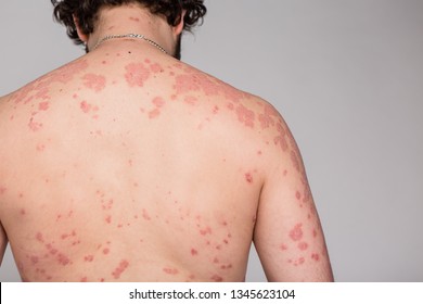 Dermatological skin disease, psoriasis, more pronounced on the elbows,Psoriasis skin. Psoriasis is an autoimmune disease that affects the skin cause skin inflammation red and scaly