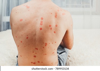 Dermatological Skin Disease, Psoriasis, Pronounced More At The Back