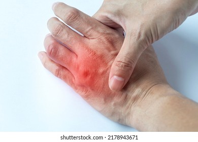 Dermatological Skin Diseases Concept : Young Man Held A Painful Hand That Was Reddened, Inflamed Body Parts Causes Discomfort And Itching, Suffering From Bouts Of Allergies.