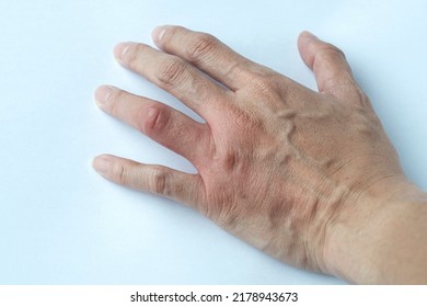 Dermatological Skin Diseases Concept : Young Man A Painful Hand, Inflamed Body Parts Causes Discomfort And Itching, Suffering From Bouts Of Allergies.