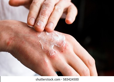 Dermatologist Doctor Doing Treatment, Male Patient With Allergic Rash Dermatitis Eczema Skin, Skin Diseases.